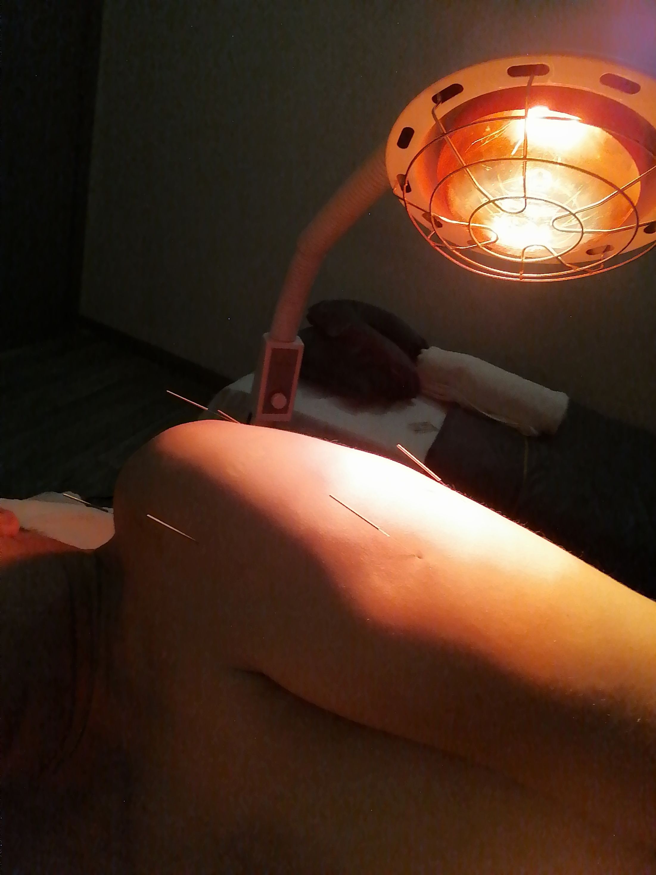 Séance d'acuponcture