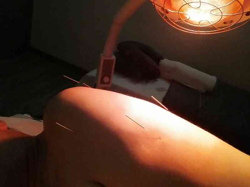 Séance d'acuponcture
